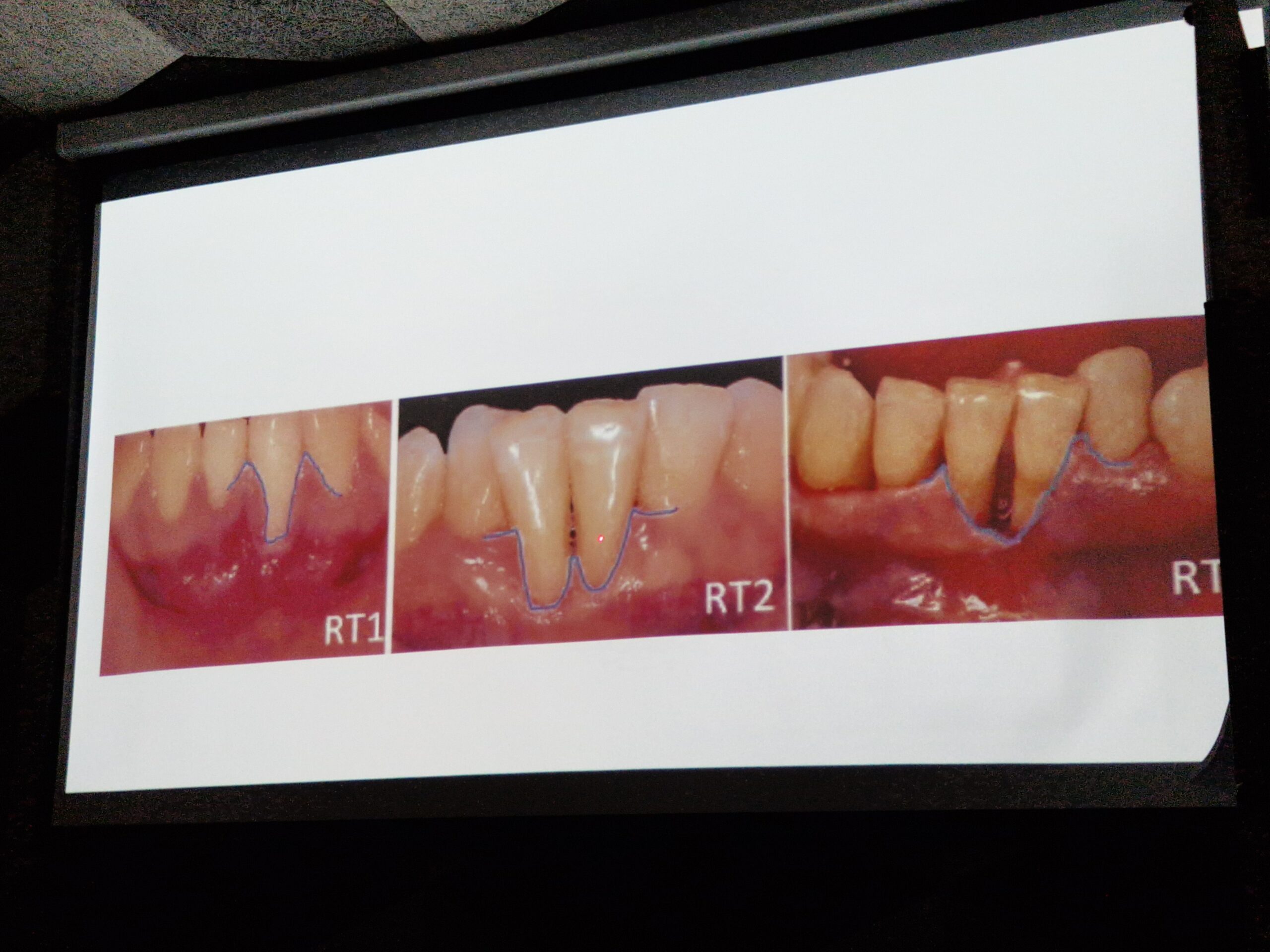 Лікар-пародонтолог нашої клініки Рукавіцина Катерина вдосконалює свої знання на курсі «Від класики до інновацій: вибір методики лікування рецесій ясен»